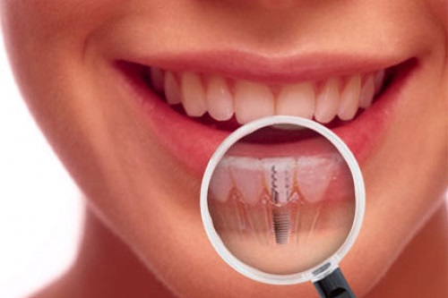 Trồng răng implant có đau không? Cần lưu ý gì 3 Trồng răng implant có đau không? Cần lưu ý gì 3