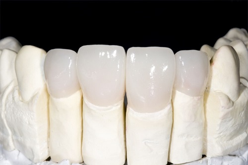 Giải pháp phục hình răng với bọc răng sứ cercon 1