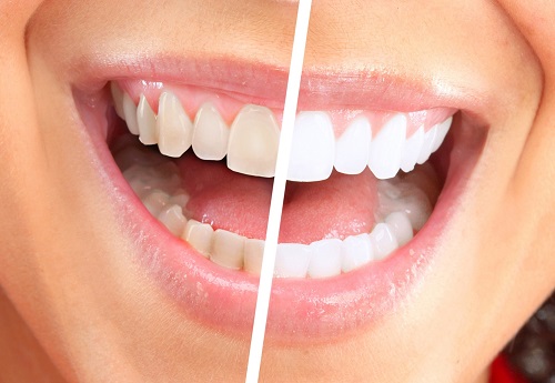 Chuyên gia giải đáp - Bọc răng sứ có ảnh hưởng gì không? 3