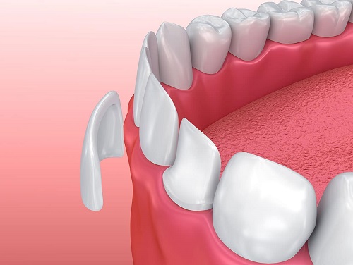 Bọc răng sứ không cần mài răng hiệu quả nhất tại nha khoa 1
