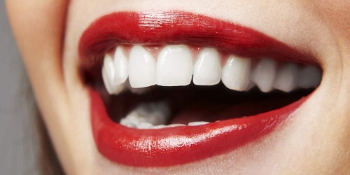 Bọc răng sứ không cần mài răng hiệu quả nhất tại nha khoa 2