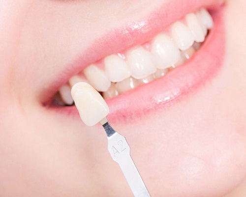 Bọc răng sứ kim loại thường nên lưu ý điều gì? 2