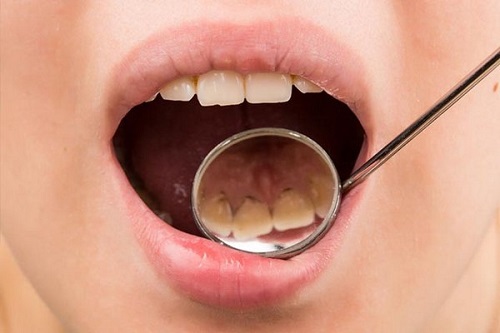 Cạo vôi răng có tốt không? Lợi và hại khi cạo vôi răng 4