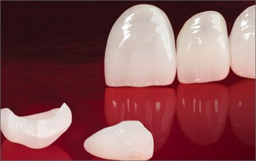 Chụp răng sứ giá bao nhiêu đảm bảo chất lượng cho khách hàng 1