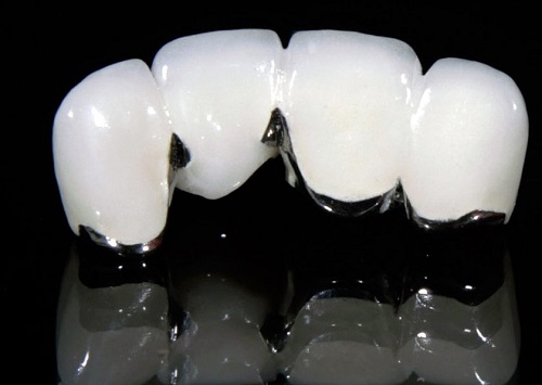 Làm cầu răng sứ giá bao nhiêu? Trường hợp nào nên làm cầu răng sứ 3