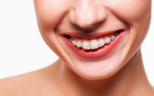 Niềng răng 1 hàm bao nhiêu tiền? Có khác với niềng răng nguyên hàm không 3