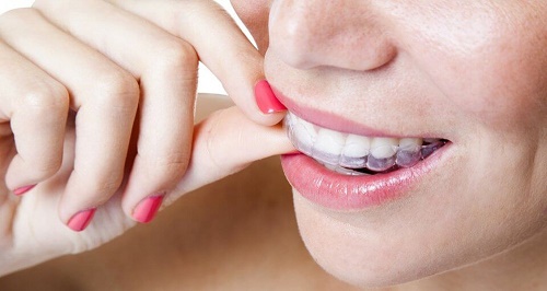 Niềng răng bao lâu thì nên có bầu? Cần tư vấn 4