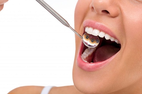 Bạn đang lo lắng niềng răng bị hở lợi - Giải pháp cho bạn 3
