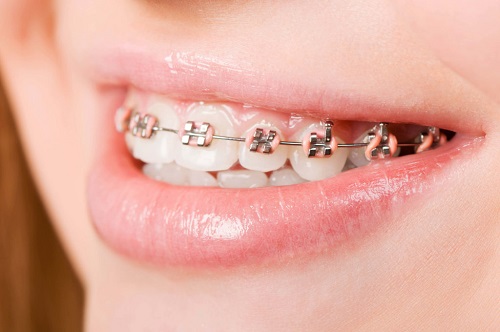 Chuyên mục hỏi đáp - Niềng răng chữa cười hở lợi có được không? 2