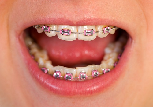 Thực hiện niềng răng có hết móm không bác sĩ? 4