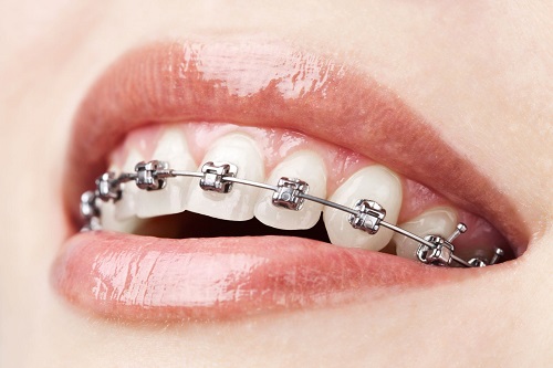 Niềng răng hàm trên mất bao lâu phụ thuộc vào điều gì 1