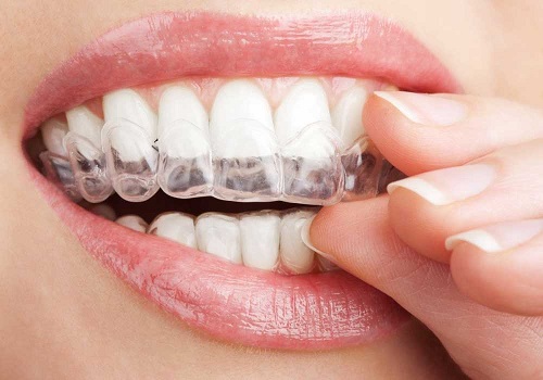 Niềng răng hàm trên mất bao lâu phụ thuộc vào điều gì 3