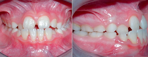 Có phương pháp niềng răng khớp cắn hở không? 1