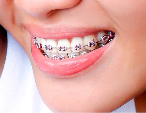 3 yếu tố để xác định niềng răng rẻ nhất Hà Nội 2