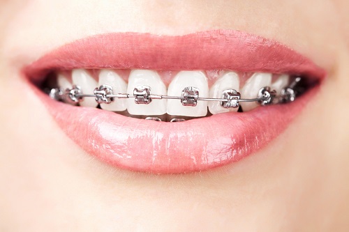 Niềng răng trả góp tphcm được thực hiện với hình thức như thế nào? 1