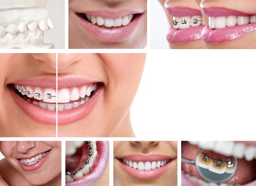 Niềng răng trả góp tphcm được thực hiện với hình thức như thế nào? 2