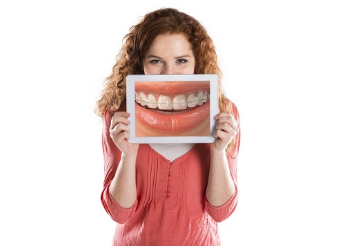 Niềng răng trả góp tphcm được thực hiện với hình thức như thế nào? 4