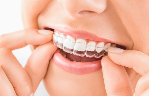 Niềng răng trong suốt có phải nhổ răng không bác sĩ? 3