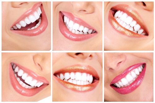 Răng sứ bị đen viền nướu nguyên nhân chính do đâu? 2