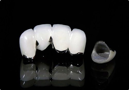 Răng sứ titan có bị đen không? 3 điều cần biết về răng sứ titan 1