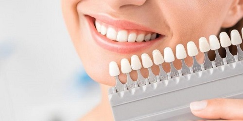Tẩy trắng răng có đắt không? Mấy tuổi thì tẩy trắng răng được? 2