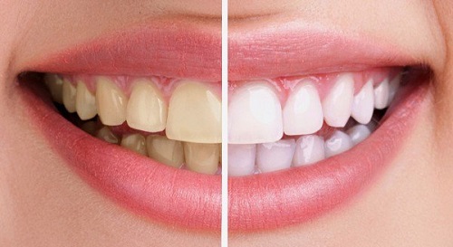 Tẩy trắng răng có nguy hiểm không? Cần nắm thông tin gì trước khi tẩy trắng? 1
