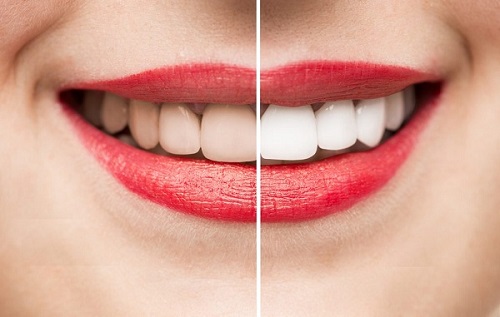 Tẩy trắng răng không nên ăn gì? Cùng tìm hiểu với Yến Vy 1