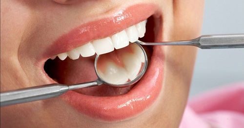 Giải pháp khắc phục răng thưa - Bọc răng cửa bị thưa 3 Giải pháp khắc phục răng thưa - Bọc răng cửa bị thưa 3