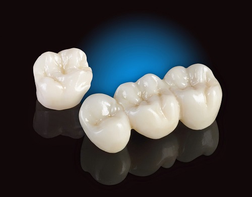Tìm hiểu bọc răng hàm bị sâu giá bao nhiêu? 2