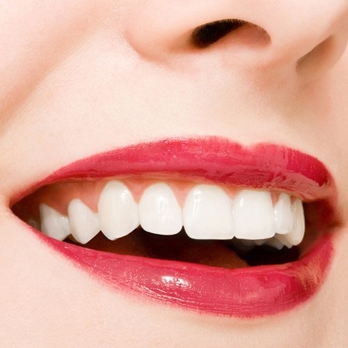  Bọc răng sứ cho răng cửa mọc lệch có giúp răng đều đặn không? 3