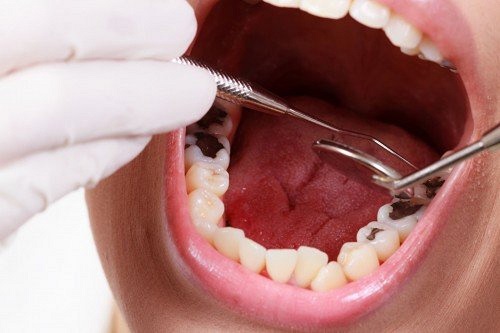 Bọc răng sứ cho răng hàm sâu có được không? 1