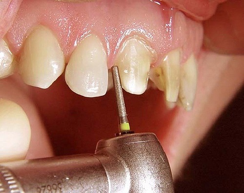 Kết quả bọc răng sứ giữ được bao lâu vậy? 3