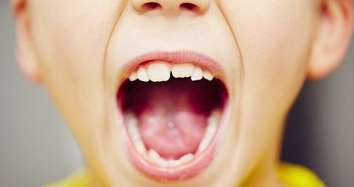 Bệnh răng miệng ở trẻ em - Phụ huynh nên tìm hiểu 3
