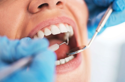 Những điều cần biết khi niềng răng bị lòi chân răng 2