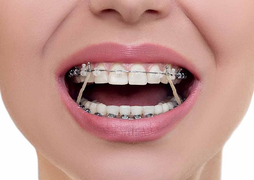 Trong quá trình niềng răng giai đoạn nào đau nhất? 1