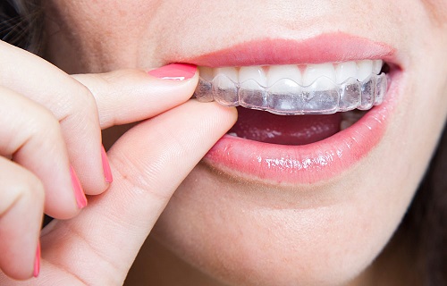 Trong quá trình niềng răng giai đoạn nào đau nhất? 2