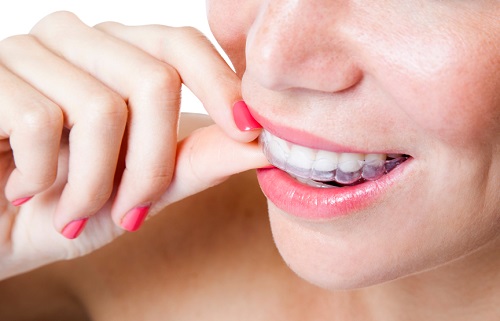 Trong quá trình niềng răng giai đoạn nào đau nhất? 4