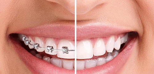Giải pháp xử lý khi niềng răng lệch nhân trung 1