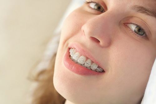 Giải pháp xử lý khi niềng răng lệch nhân trung 3