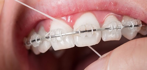 Niềng răng phải đeo hàm duy trì bao lâu vậy bác sĩ? 1