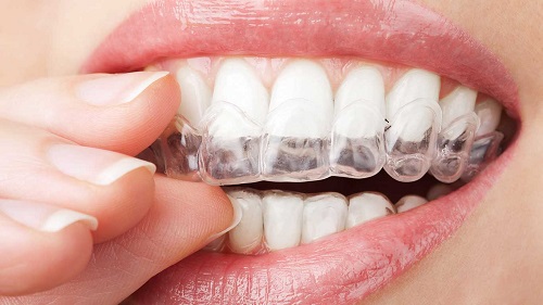 Niềng răng phải đeo hàm duy trì bao lâu vậy bác sĩ? 3