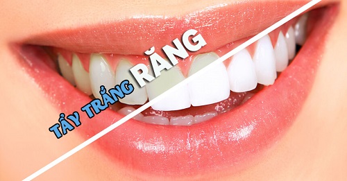 Tẩy trắng răng cho răng sâu có được không? Cần tư vấn gấp 1