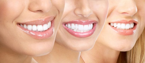 Tẩy trắng răng cho răng sâu có được không? Cần tư vấn gấp 3