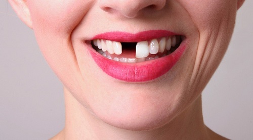 Thực hiện bọc răng sứ khi bị mất răng là một giải pháp đúng 1