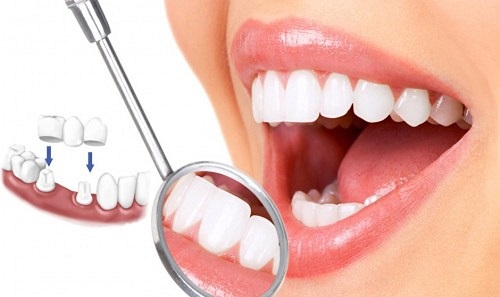 Kỹ thuật trồng răng sứ an toàn hiệu quả cao 3