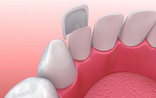 Làm răng sứ không mài răng hiệu quả thế nào? 1