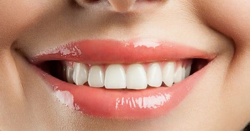 Làm răng sứ thẩm mỹ ở đâu đẹp và an toàn hiện nay? 4