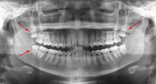 Răng khôn hàm dưới mọc lệch nên xử lý ra sao? 1