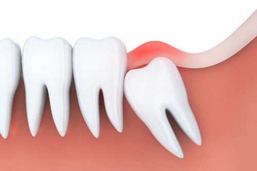 Răng khôn hàm dưới mọc lệch nên xử lý ra sao? 2