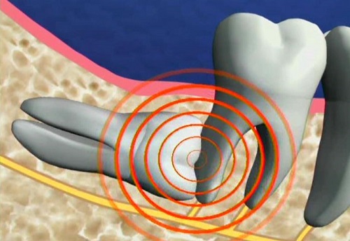 Răng khôn hàm dưới mọc lệch nên xử lý ra sao? 3